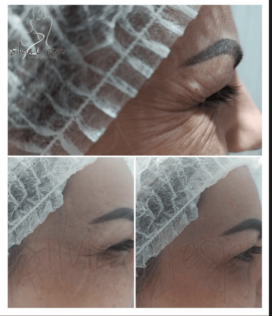 Resultado de tratamento facial — Sílvia Crespo, Araçatuba