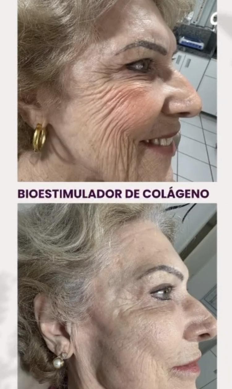 Resultado de rejuvenescimento — Clínica Sílvia Crespo, Araçatuba-SP