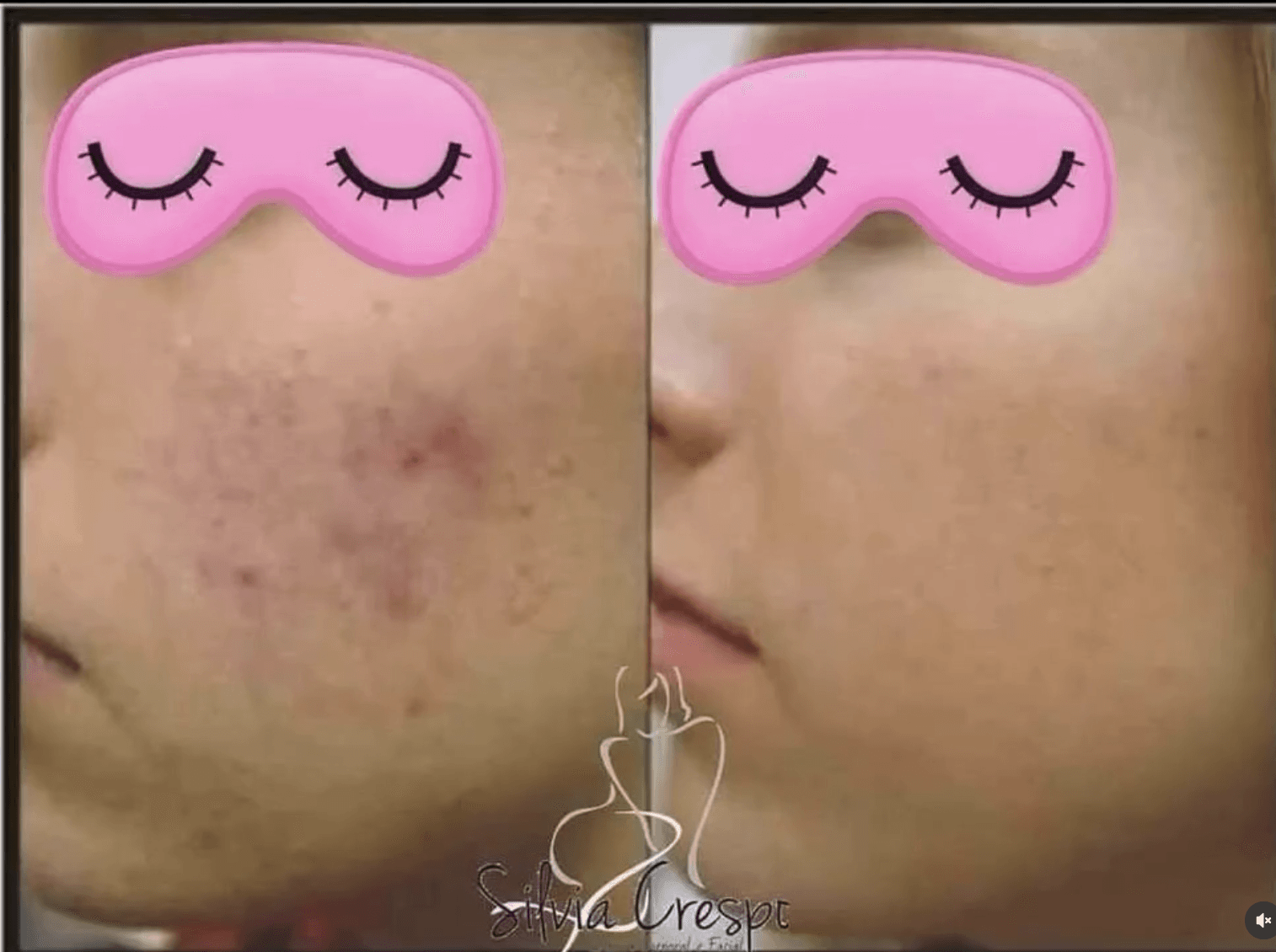 Antes e depois de tratamento de ozonioterapia para alívio de dores — Clínica Sílvia Crespo, Araçatuba