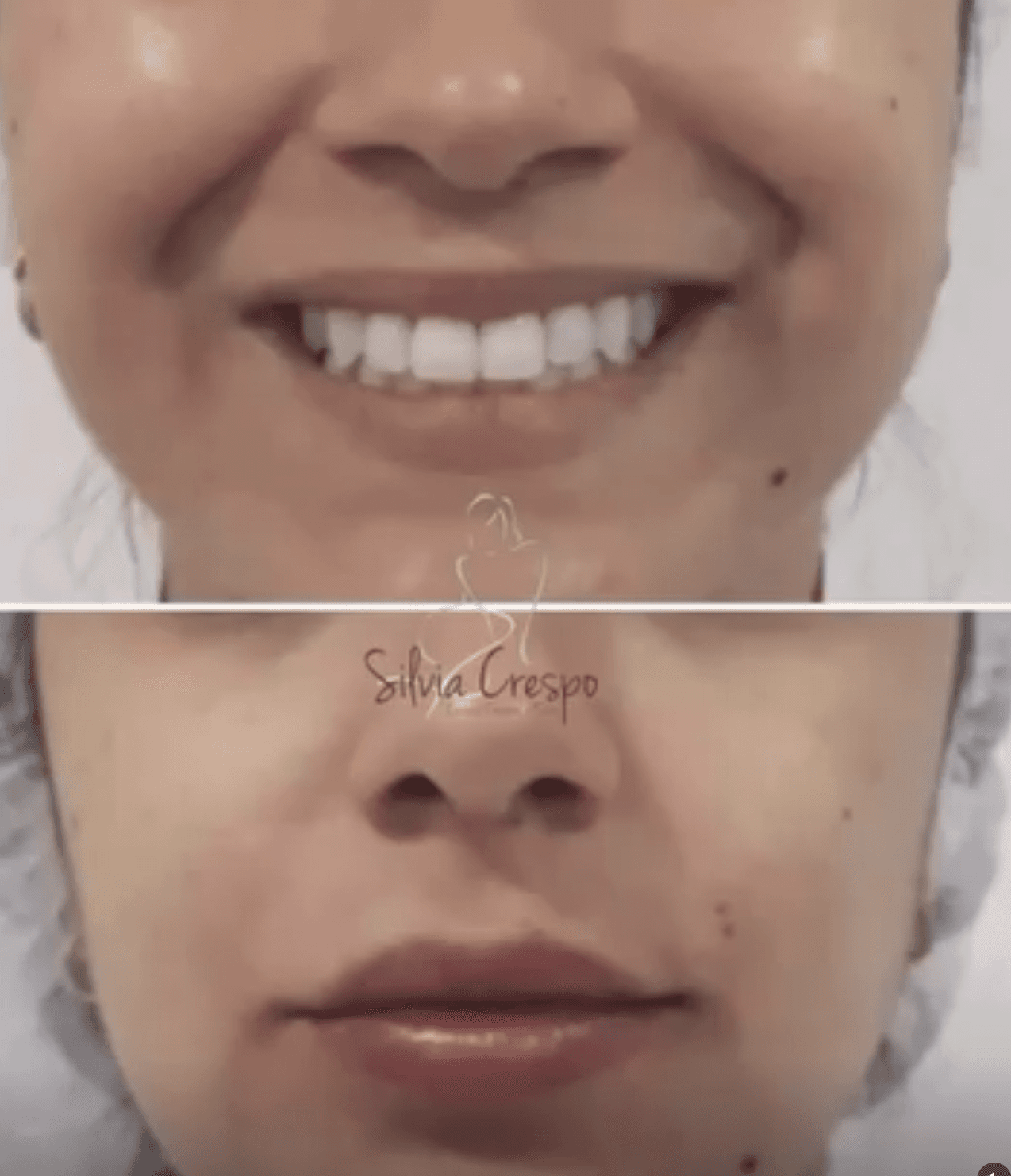 Resultado de botox e preenchimento facial com resultado natural — Sílvia Crespo, Araçatuba-SP