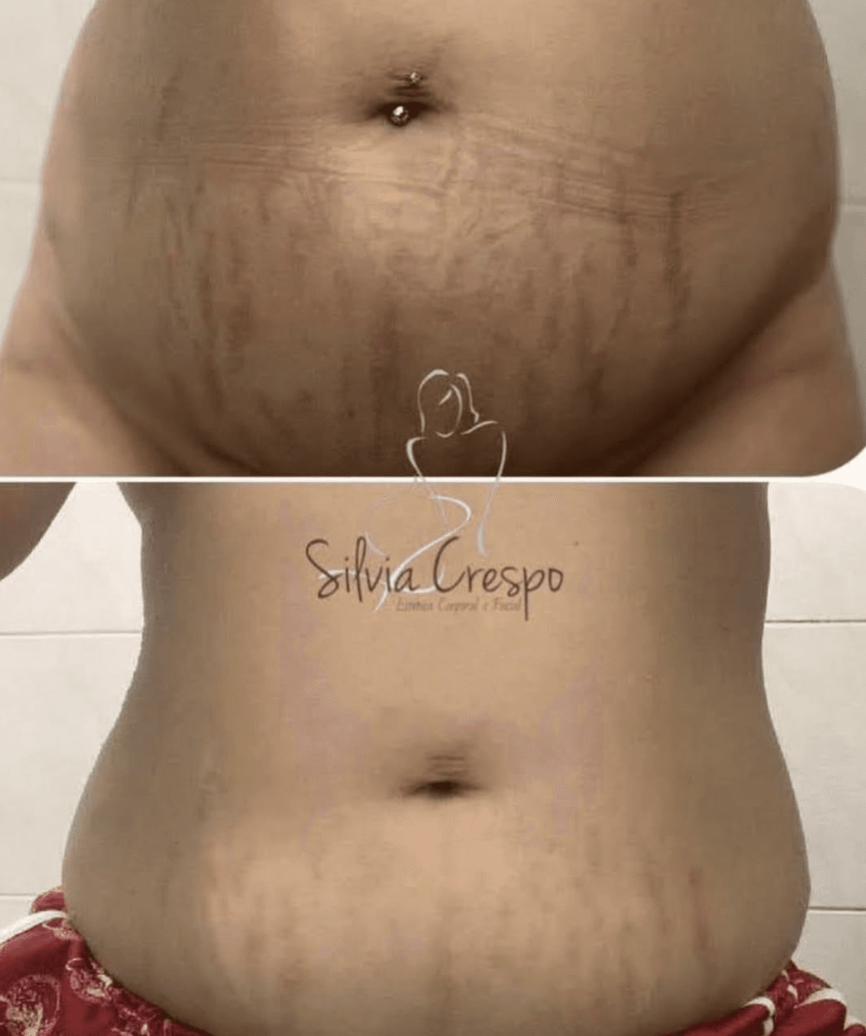 Resultado de harmonização corporal com bioestimulador de colágeno — Araçatuba