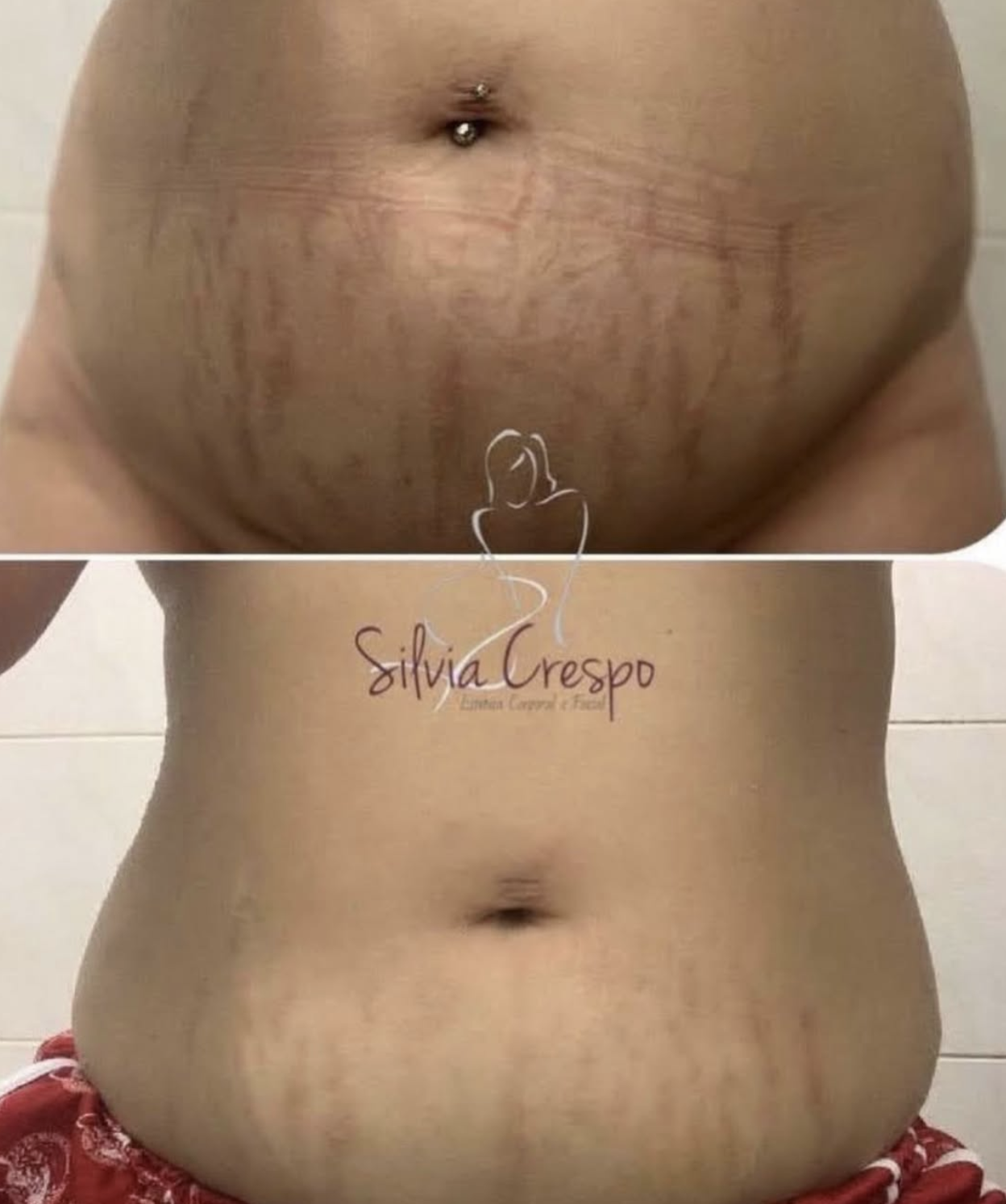 Resultado de tratamento de harmonização corporal