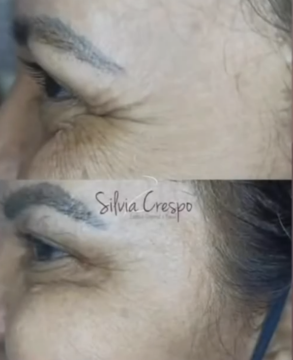 Resultado de tratamento de rejuvenescimento facial